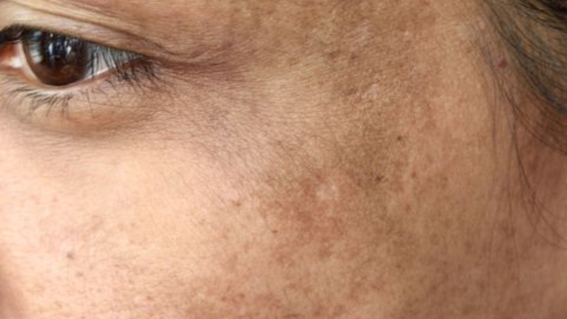 Alpha Arbutin vs Hydroquinone: The Safe Way to Fade Dark Spots