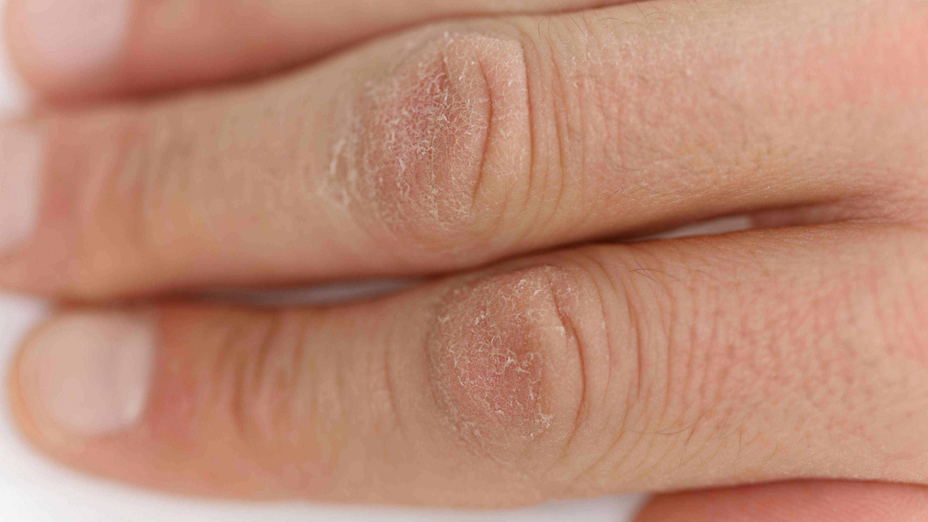 Best Moisturizer for Dry Skin in Pakistan | Why a Lotion Beats a Cream