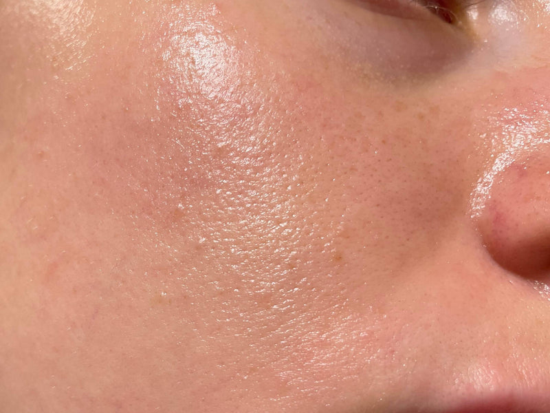 Best Serum for Oily Skin in Pakistan | Oil Control That Actually Works