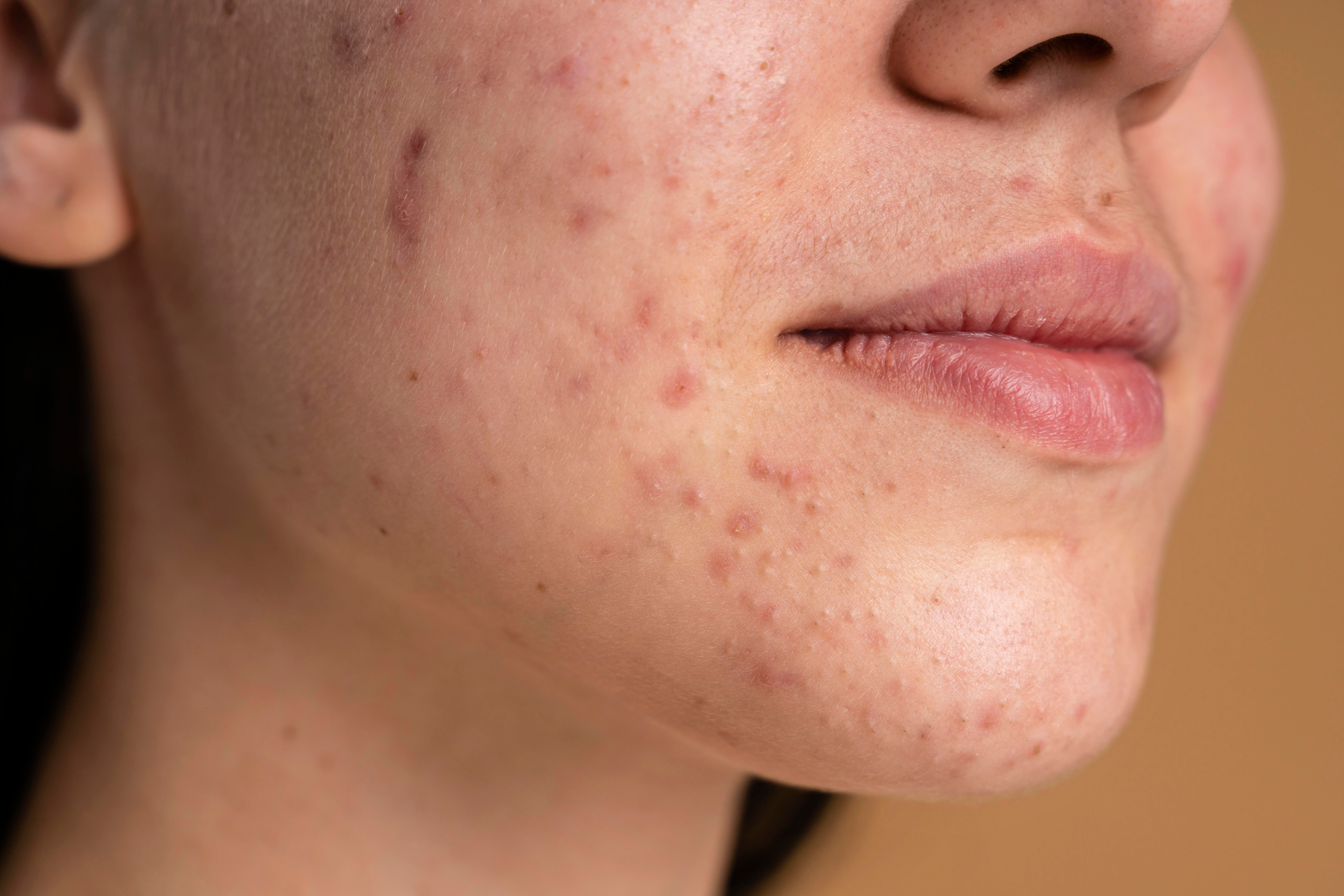 Best Serum for Acne in Pakistan | Ingredients That Actually Clear Skin