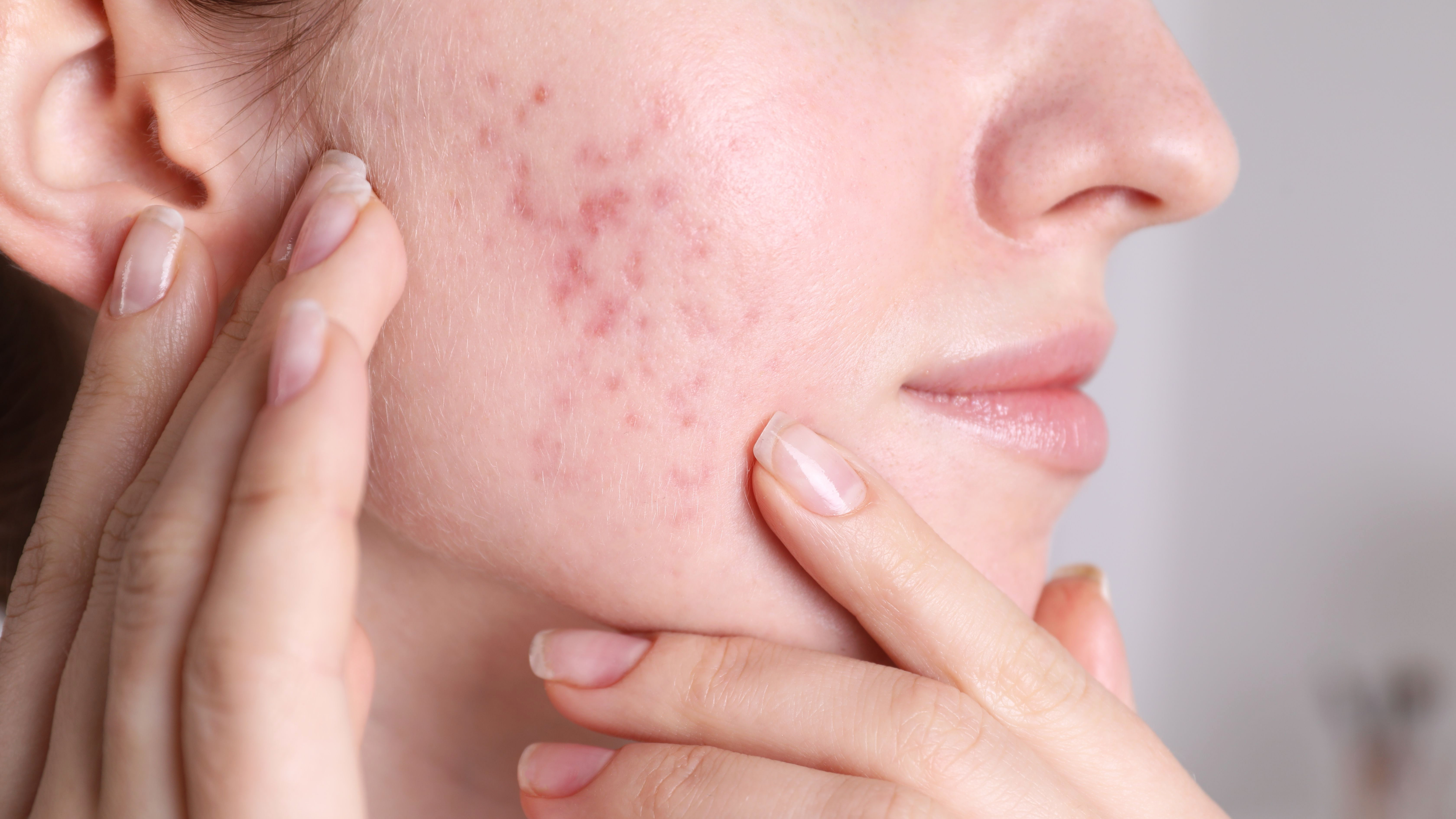 Mandelic Acid for Acne: Why It Works Better Than Salicylic Acid