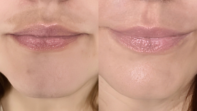 Dark Upper Lip and Pigmentation Around the Mouth: Causes and Treatment
