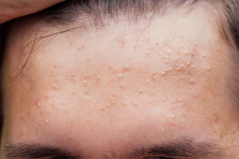 Fungal Acne: Why Your Acne Treatment Might Be Making It Worse