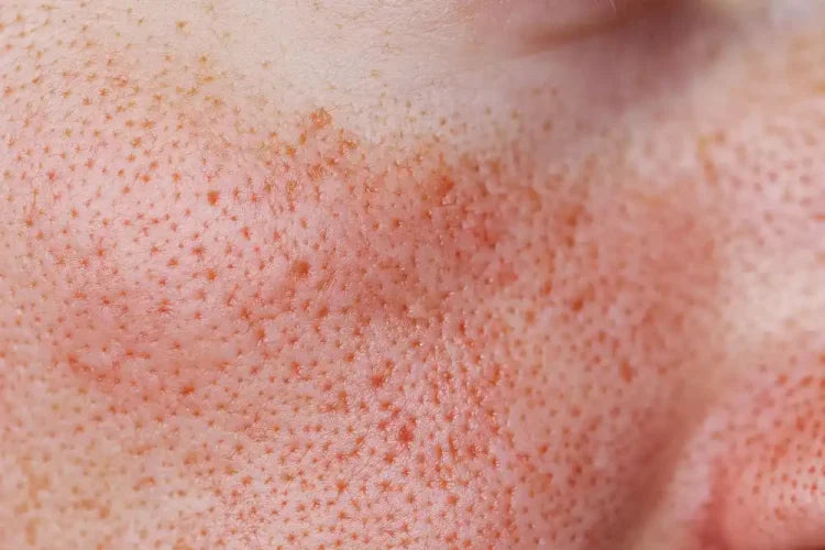 How to Minimize Open Pores | What Works and What Is a Myth