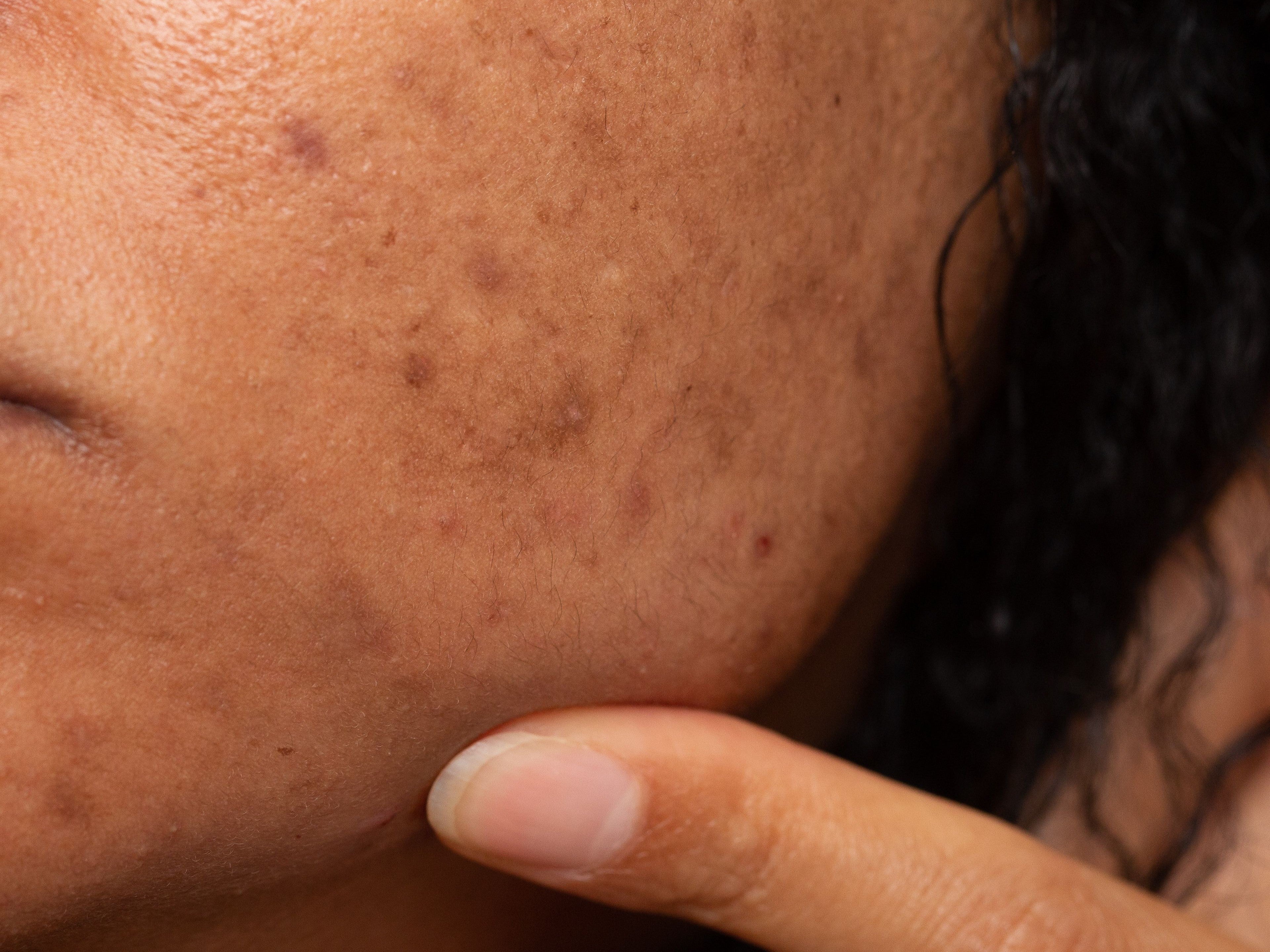 How to Remove Dark Spots from Face: The Complete Guide for Pakistani Skin
