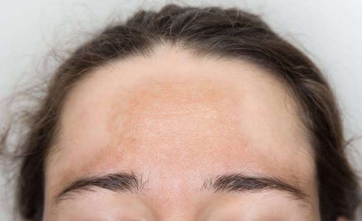 Melasma Treatment in Pakistan | Why It Keeps Coming Back and What Actually Works