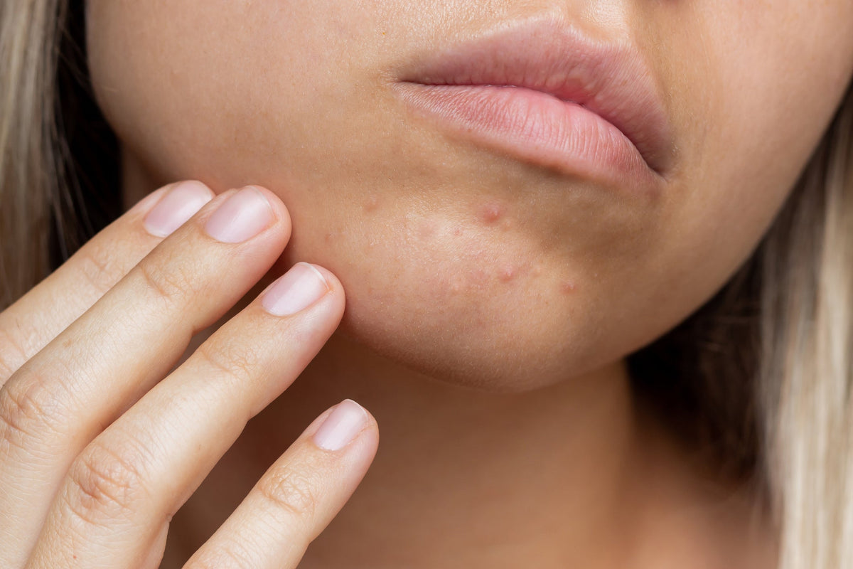 Pimples on Chin and Jawline: Why They Keep Coming Back